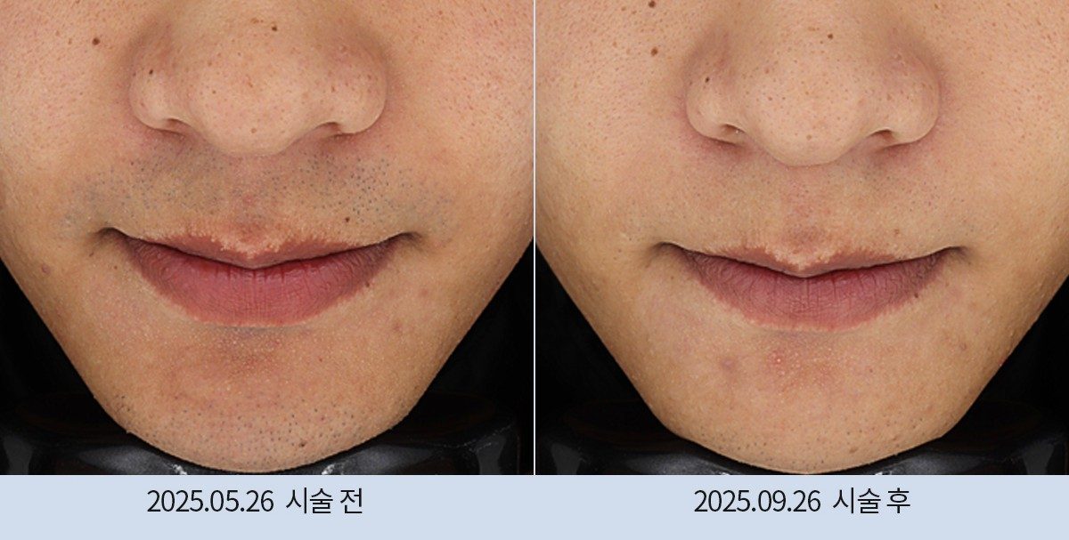 스노우의원 다산점 레이저 제모 전후