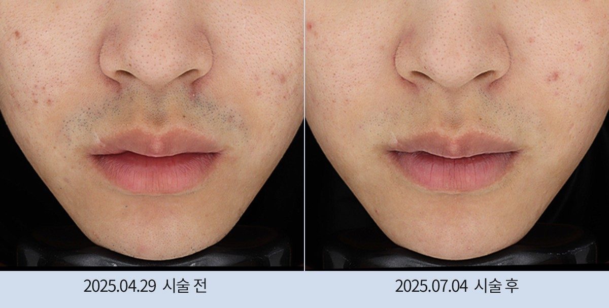 스노우의원 다산점 레이저 제모 전후